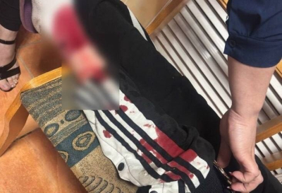 Очередное нападение: в Татарстане бродячая собака разорвала ногу ребенку 05/06/2026 – Новости